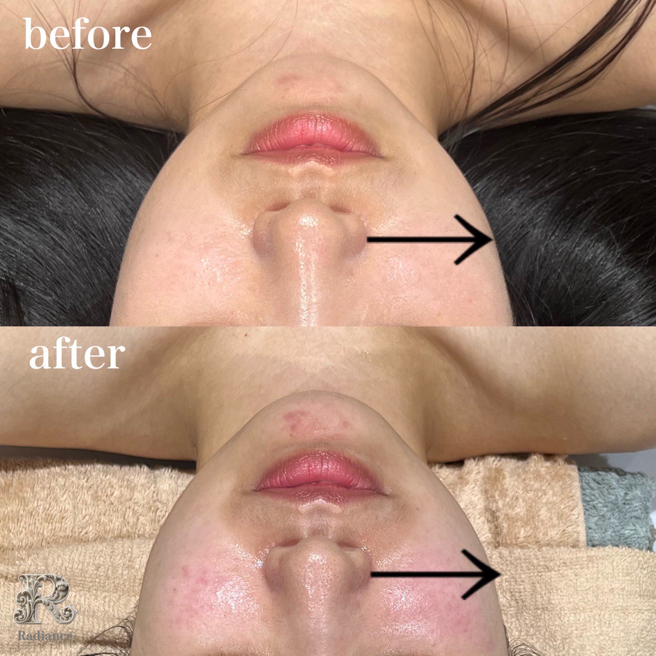 Radianceの小顔コルギ施術ビフォーアフター|フェイスラインがすっきり改善した実際のお客様の変化