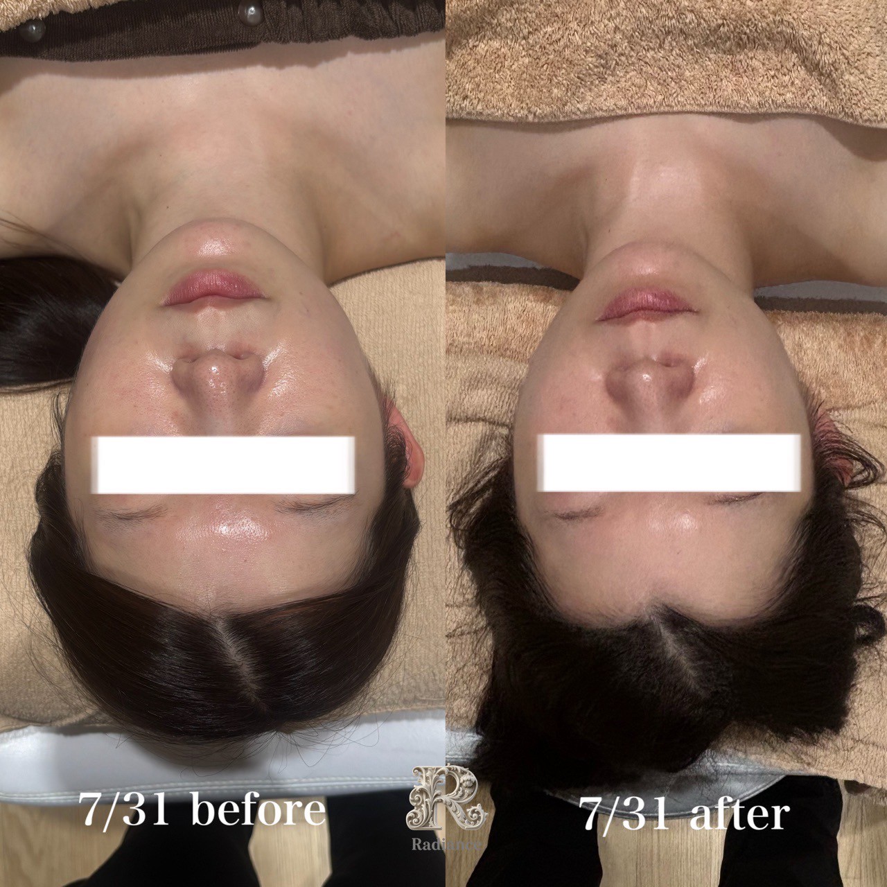Radiance 施術前後の変化 肌質改善ビフォーアフター