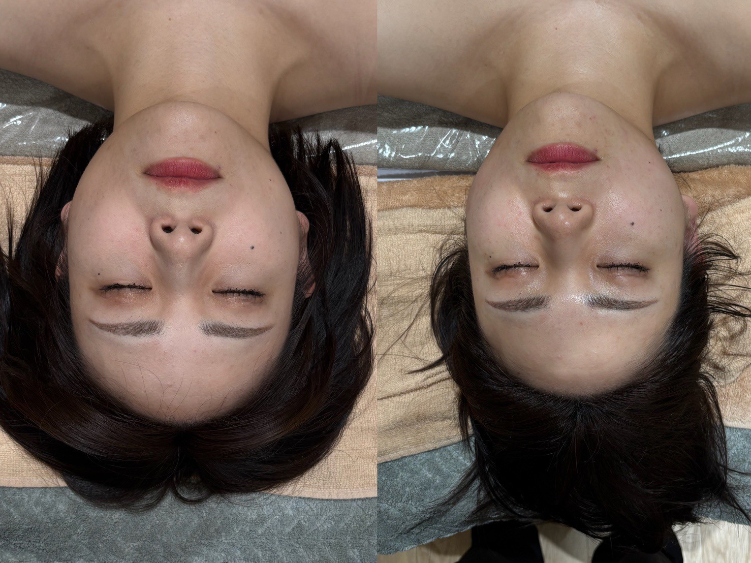 Radiance お客様の施術前後の変化